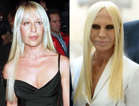 donatella versace before plastic surgery.